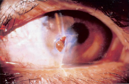 Corneal laceration with prolapse of iris